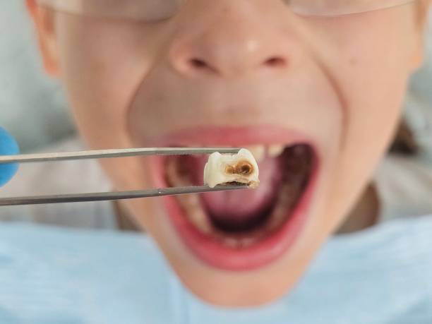 Best Emergency Tooth Extraction in Leipsic, OH